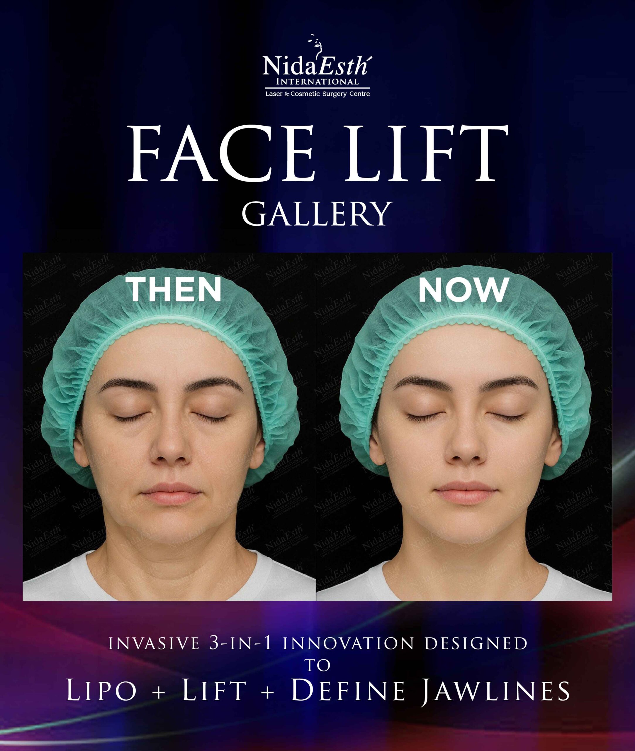 before and after facelift gallery