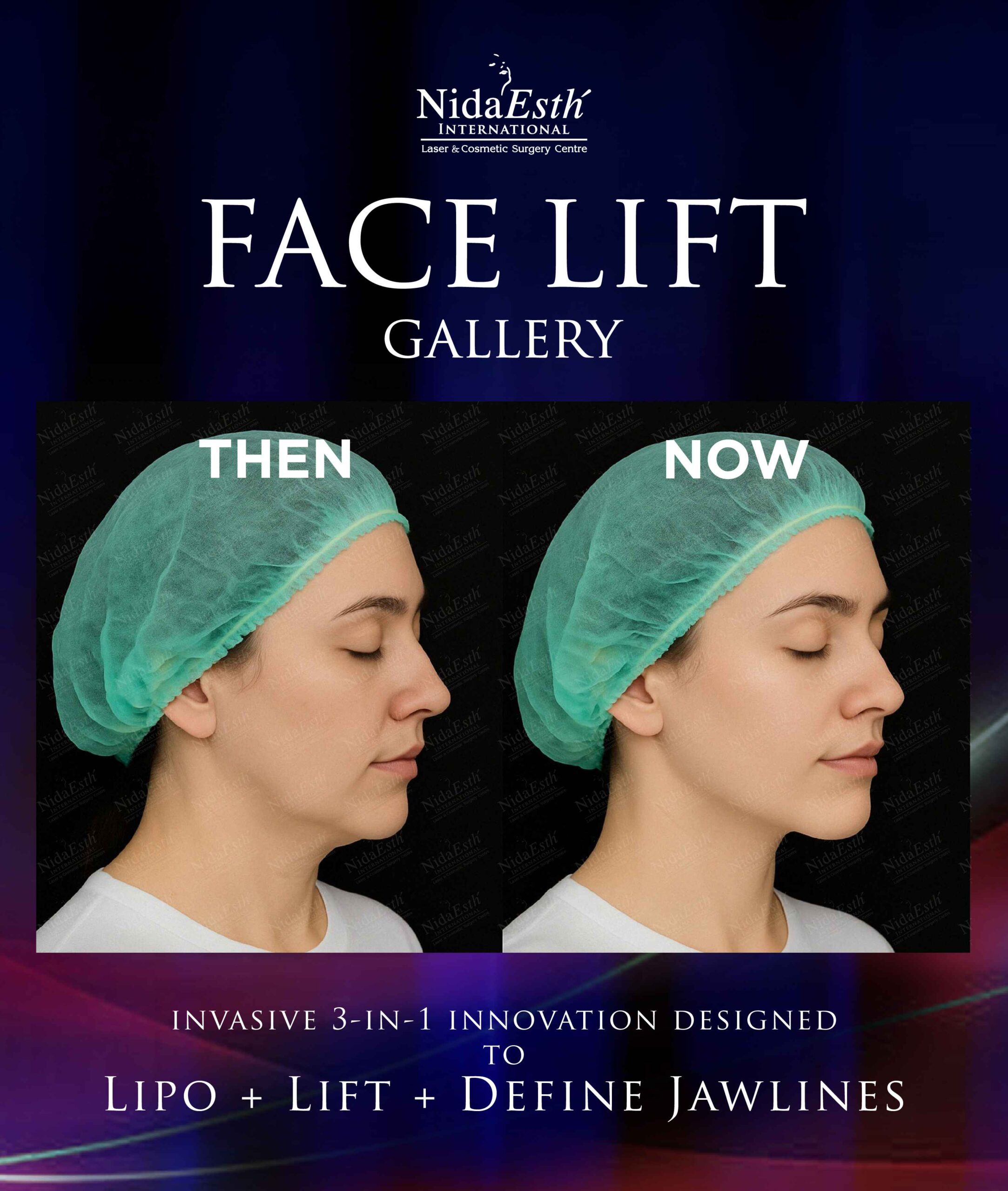 before and after facelift gallery