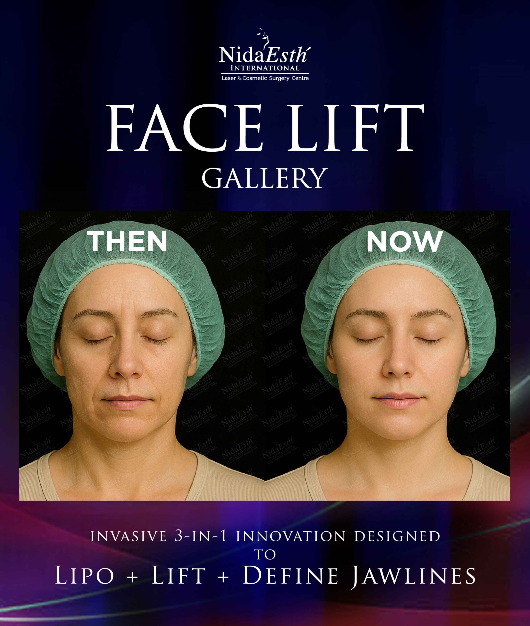 before and after facelift gallery