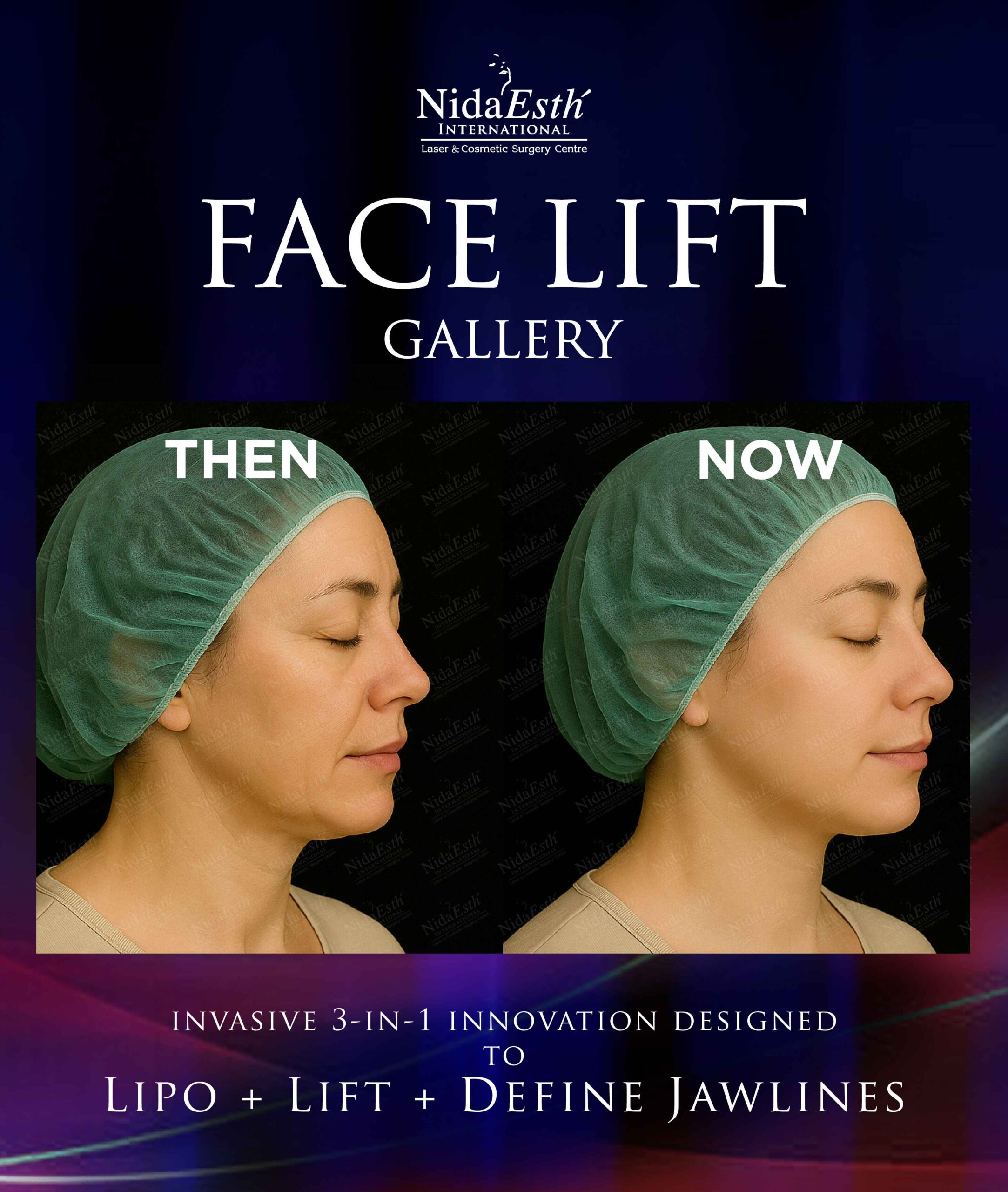 before and after facelift gallery
