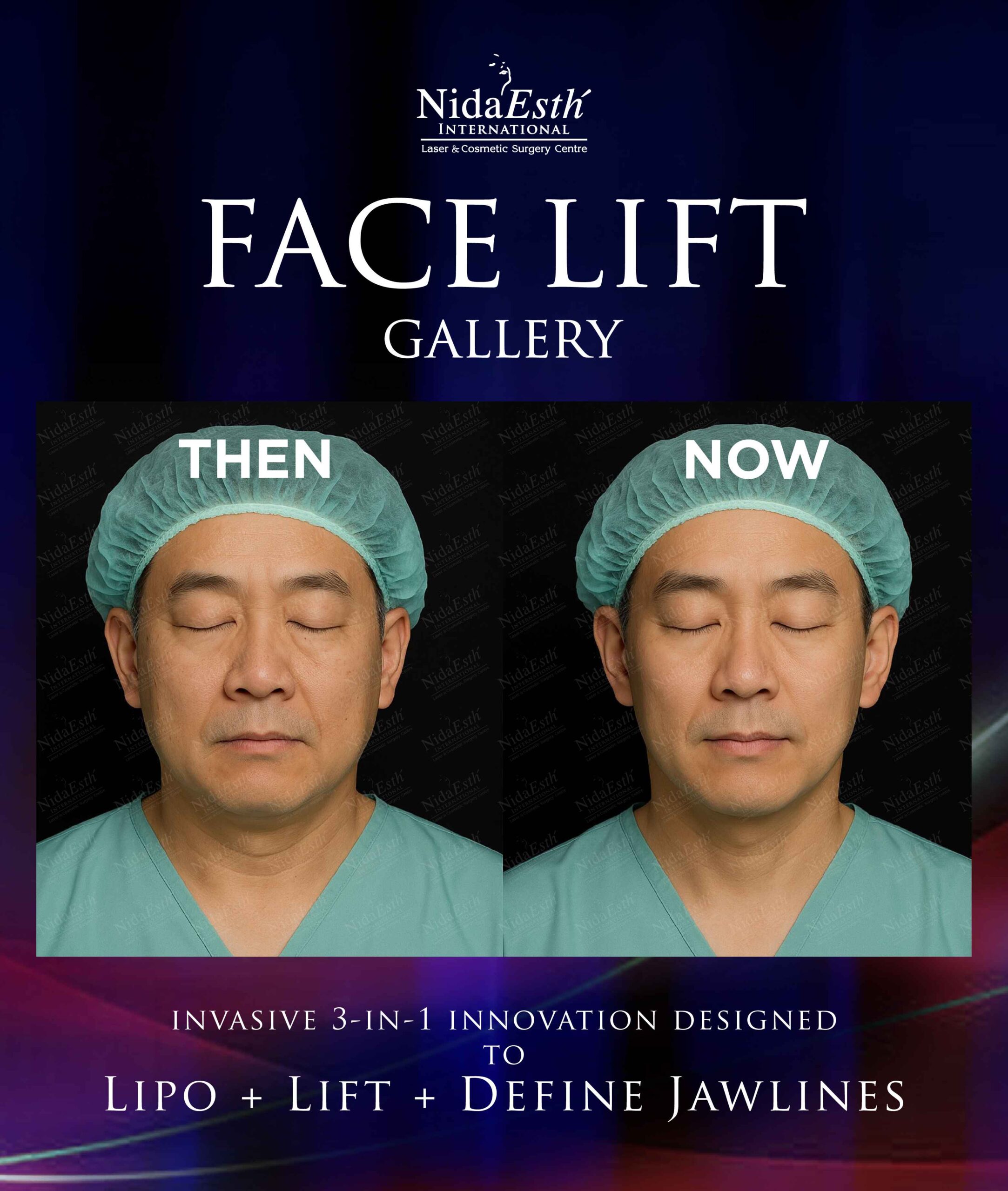 before and after facelift gallery