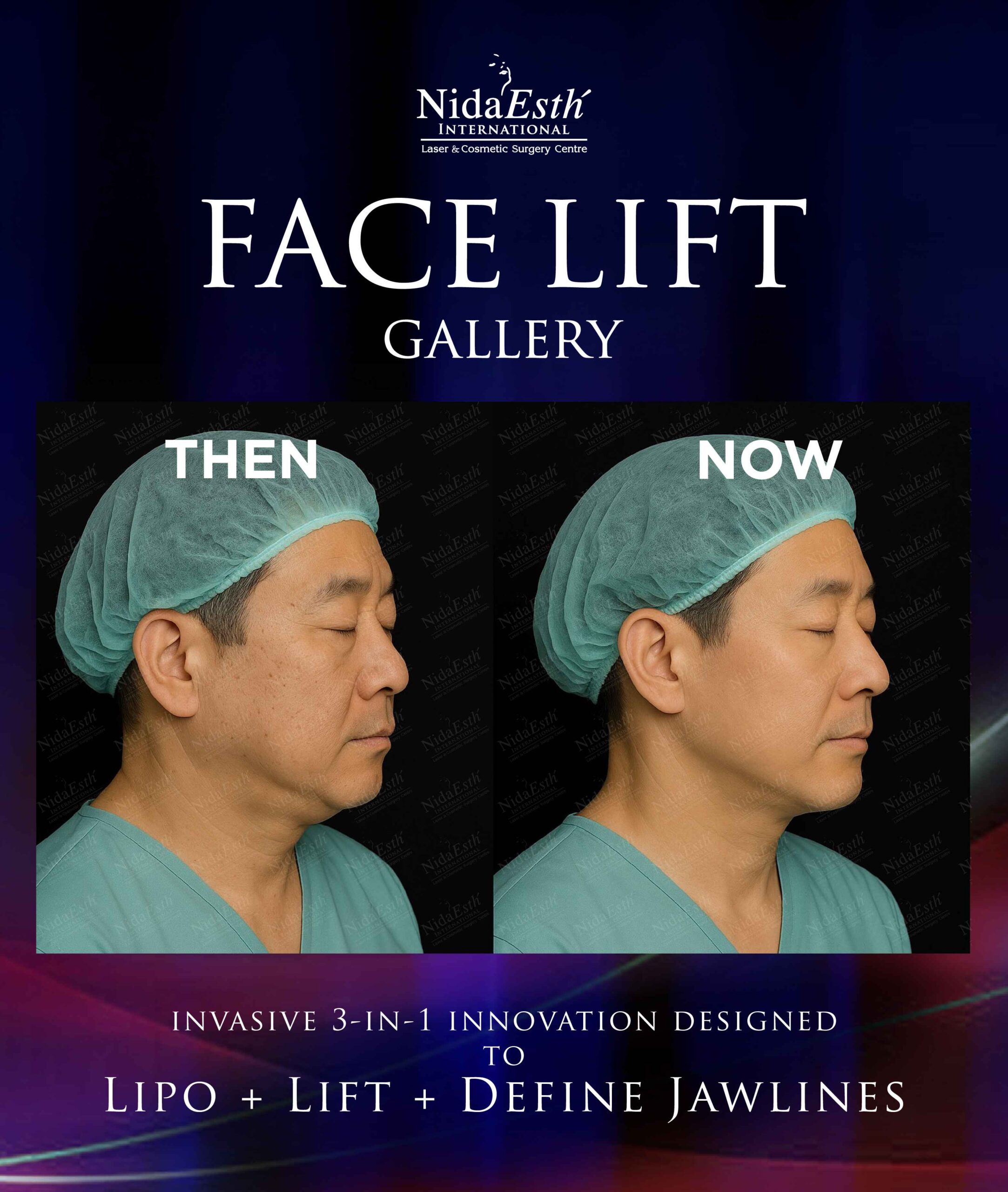 before and after facelift gallery