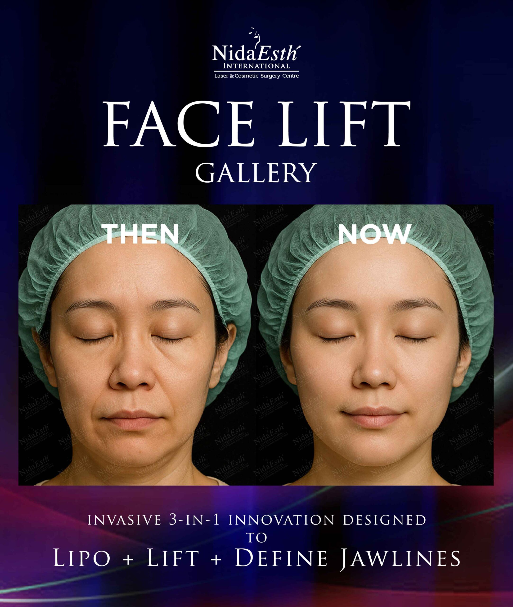 before and after facelift gallery