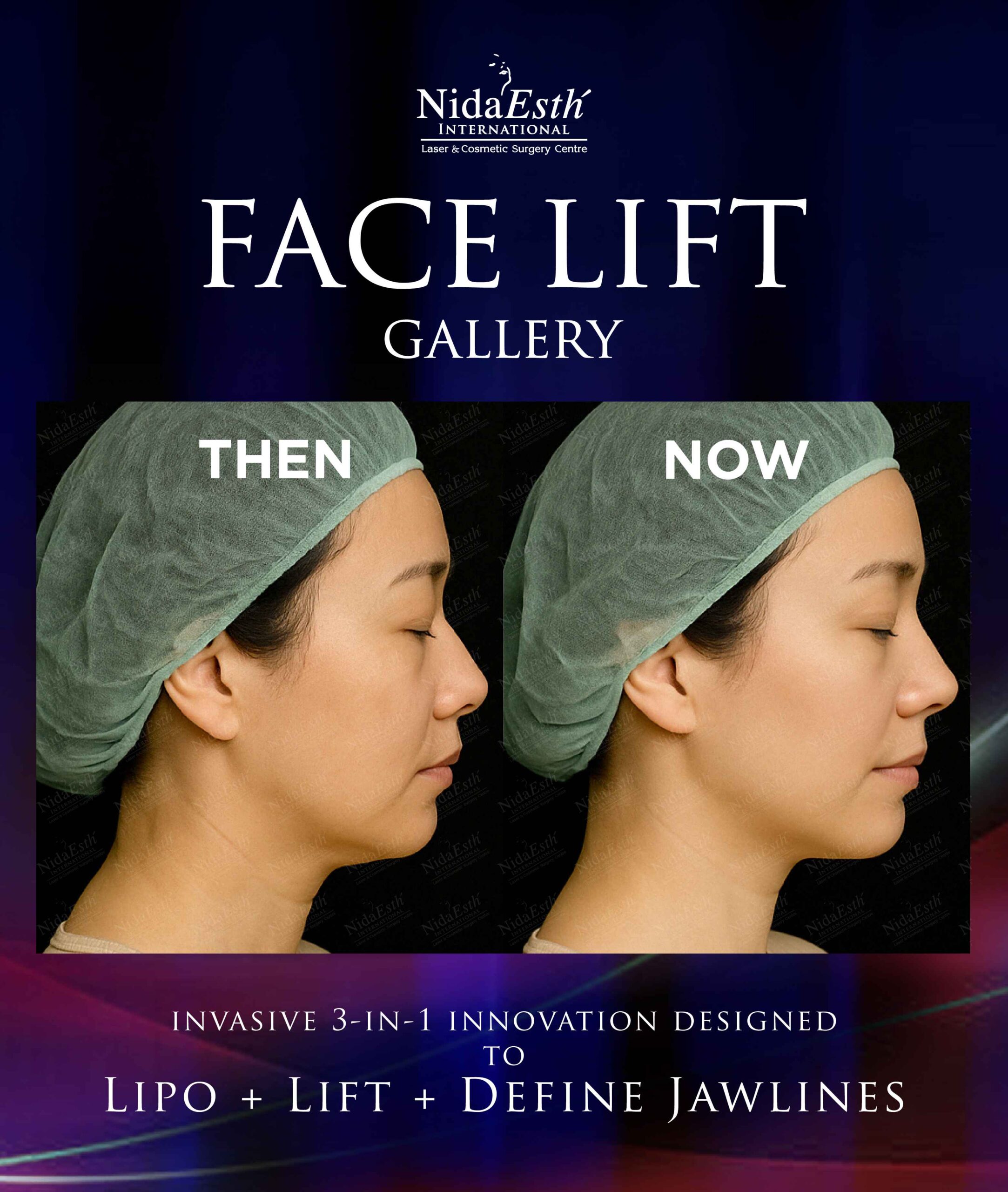 before and after facelift gallery